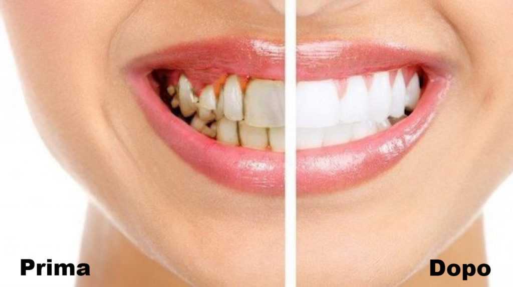 denti low cost prima e dopo